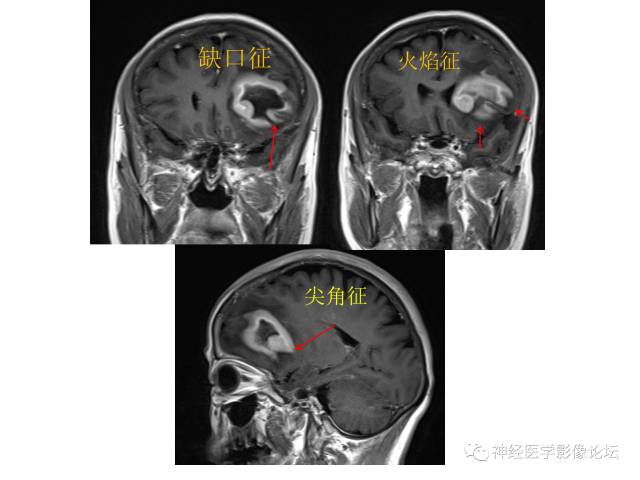 【病例】左额叶淋巴瘤1例MR影像表现