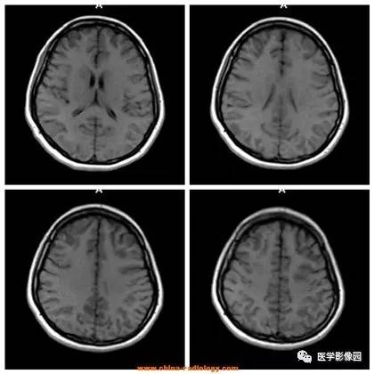 【病例】可逆性后部脑病综合征1例CT及MR 【病例】可逆性后部脑病综合征1例CT及MR
