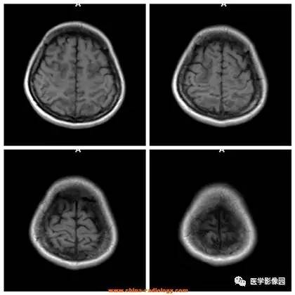 【病例】可逆性后部脑病综合征1例CT及MR 【病例】可逆性后部脑病综合征1例CT及MR