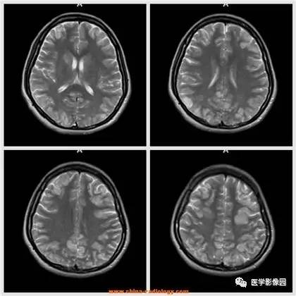 【病例】可逆性后部脑病综合征1例CT及MR 【病例】可逆性后部脑病综合征1例CT及MR
