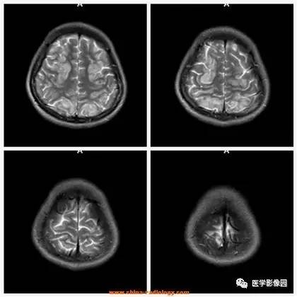 【病例】可逆性后部脑病综合征1例CT及MR 【病例】可逆性后部脑病综合征1例CT及MR