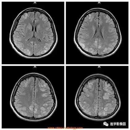 【病例】可逆性后部脑病综合征1例CT及MR 【病例】可逆性后部脑病综合征1例CT及MR