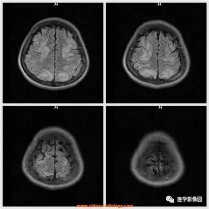 【病例】可逆性后部脑病综合征1例CT及MR 【病例】可逆性后部脑病综合征1例CT及MR