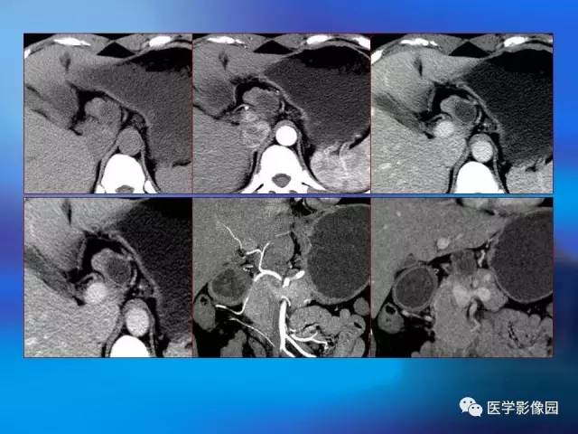 【病例】无功能胰岛细胞瘤1例CT影像表现