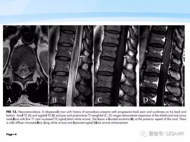 【PPT】脊髓非肿瘤性病变的MR