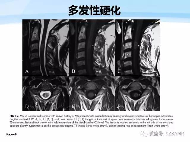 【PPT】脊髓非肿瘤性病变的MR