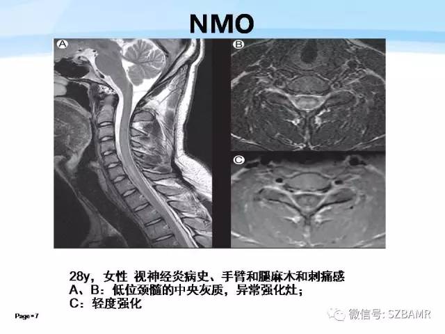 【PPT】脊髓非肿瘤性病变的MR
