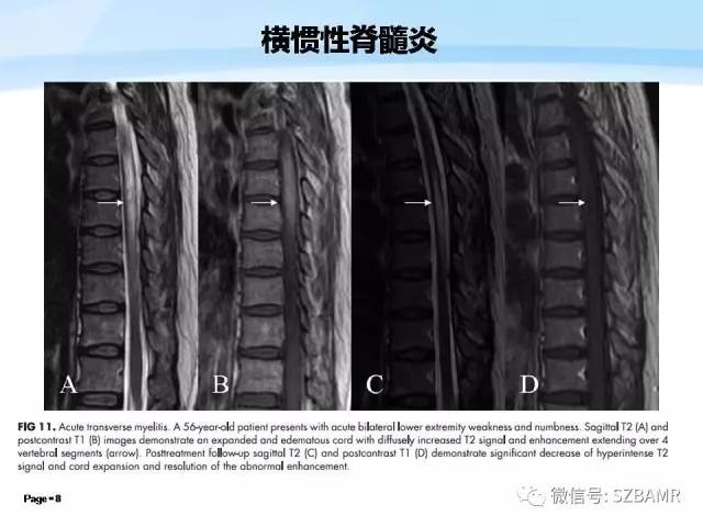 【PPT】脊髓非肿瘤性病变的MR