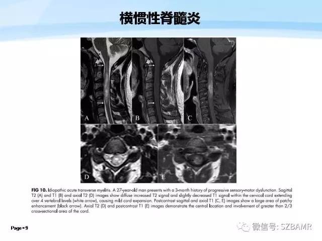 【PPT】脊髓非肿瘤性病变的MR
