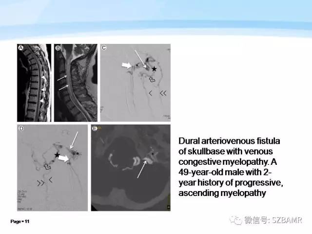 【PPT】脊髓非肿瘤性病变的MR