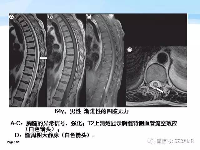 【PPT】脊髓非肿瘤性病变的MR