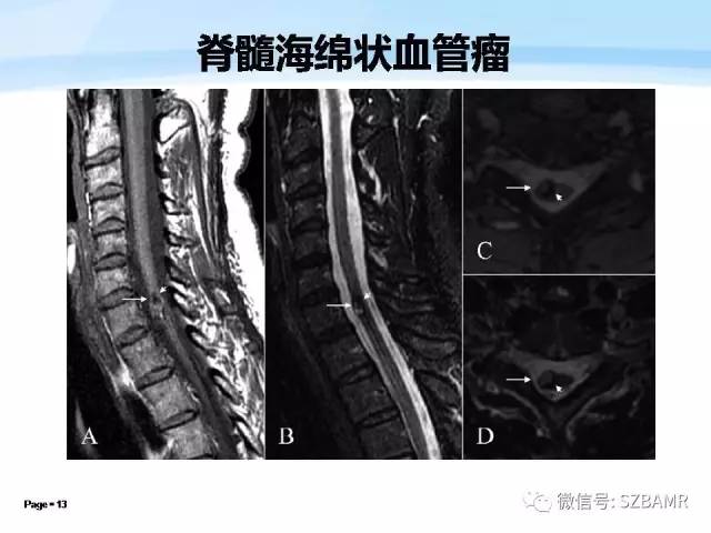 【PPT】脊髓非肿瘤性病变的MR