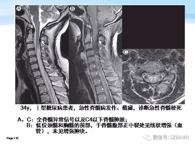 【PPT】脊髓非肿瘤性病变的MR