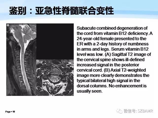 【PPT】脊髓非肿瘤性病变的MR