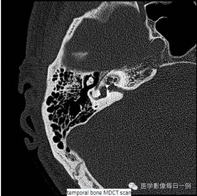 【病例】耳硬化症1例CT 【病例】耳硬化症1例CT