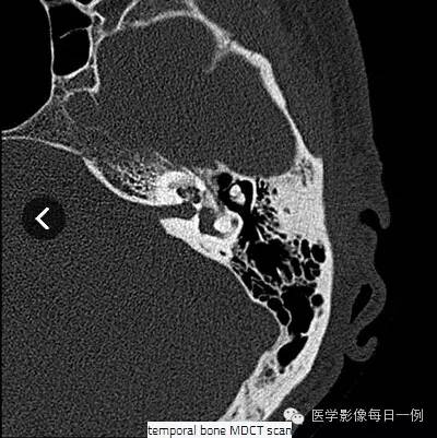 【病例】耳硬化症1例CT 【病例】耳硬化症1例CT