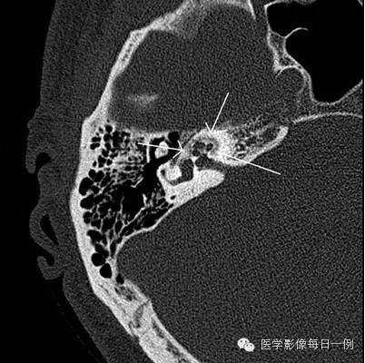 【病例】耳硬化症1例CT