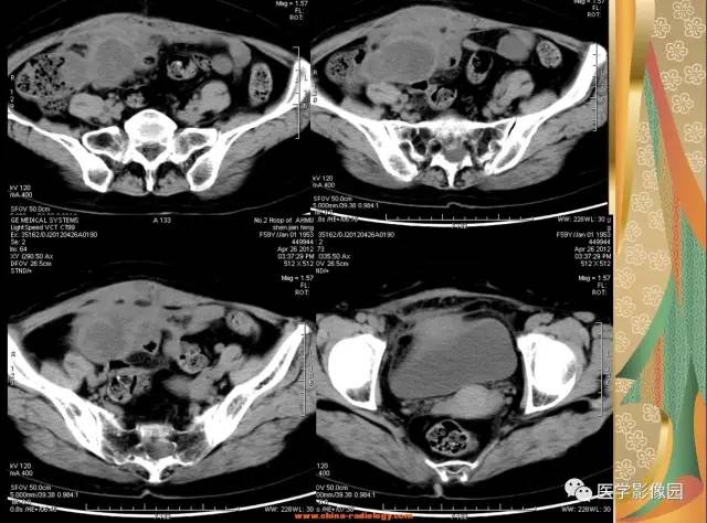 【病例】右半结肠粘液腺癌1例CT影像表现