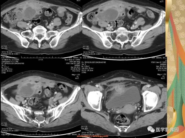 【病例】右半结肠粘液腺癌1例CT影像表现