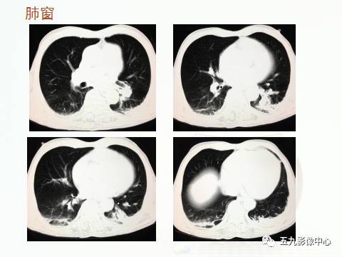 【病例】血管高密度征——急性肺动脉栓塞1例CT影像表现 【病例】血管高密度征——急性肺动脉栓塞1例CT影像表现