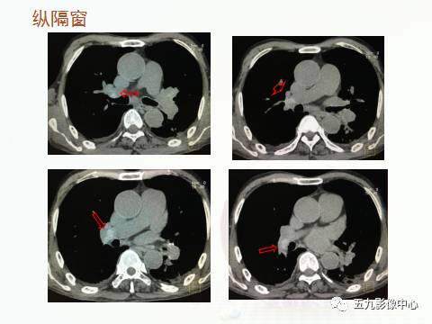 【病例】血管高密度征——急性肺动脉栓塞1例CT影像表现