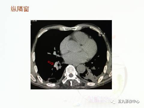 【病例】血管高密度征——急性肺动脉栓塞1例CT影像表现 【病例】血管高密度征——急性肺动脉栓塞1例CT影像表现