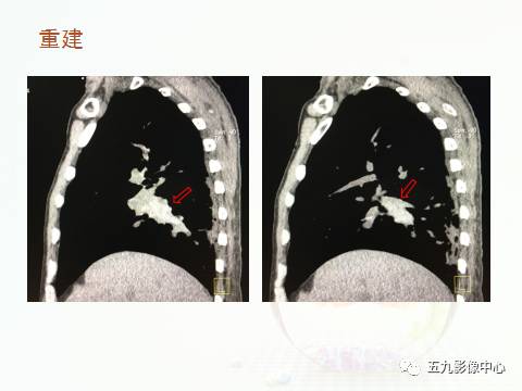 【病例】血管高密度征——急性肺动脉栓塞1例CT影像表现 【病例】血管高密度征——急性肺动脉栓塞1例CT影像表现