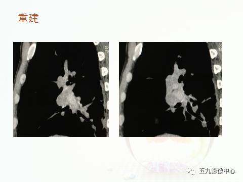 【病例】血管高密度征——急性肺动脉栓塞1例CT影像表现 【病例】血管高密度征——急性肺动脉栓塞1例CT影像表现