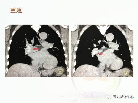 【病例】血管高密度征——急性肺动脉栓塞1例CT影像表现 【病例】血管高密度征——急性肺动脉栓塞1例CT影像表现