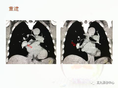 【病例】血管高密度征——急性肺动脉栓塞1例CT影像表现 【病例】血管高密度征——急性肺动脉栓塞1例CT影像表现