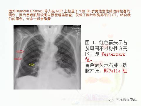 【病例】血管高密度征——急性肺动脉栓塞1例CT影像表现 【病例】血管高密度征——急性肺动脉栓塞1例CT影像表现