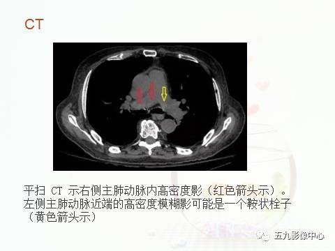 【病例】血管高密度征——急性肺动脉栓塞1例CT影像表现 【病例】血管高密度征——急性肺动脉栓塞1例CT影像表现