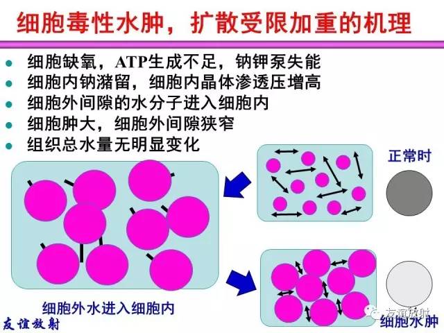 【PPT】基本病变的MRI信号分析：水肿、坏死、纤维化