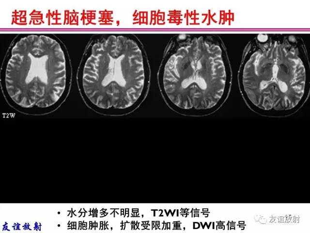 【PPT】基本病变的MRI信号分析：水肿、坏死、纤维化