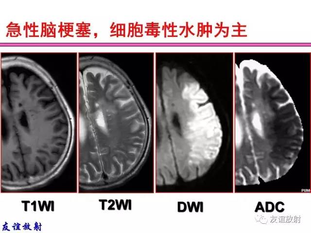 【PPT】基本病变的MRI信号分析：水肿、坏死、纤维化