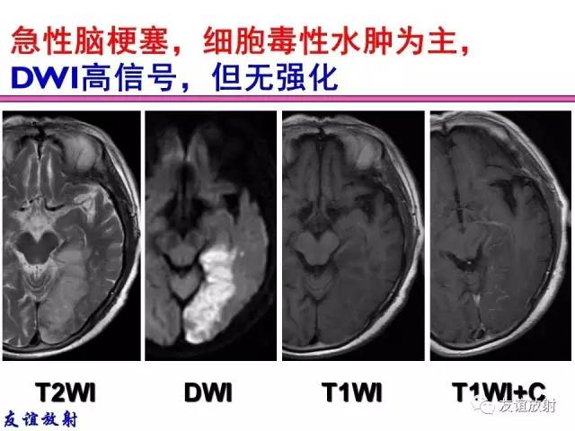 【PPT】基本病变的MRI信号分析：水肿、坏死、纤维化