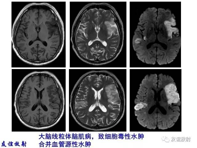 【PPT】基本病变的MRI信号分析：水肿、坏死、纤维化