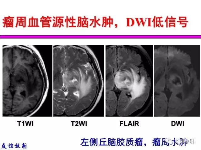 【PPT】基本病变的MRI信号分析：水肿、坏死、纤维化