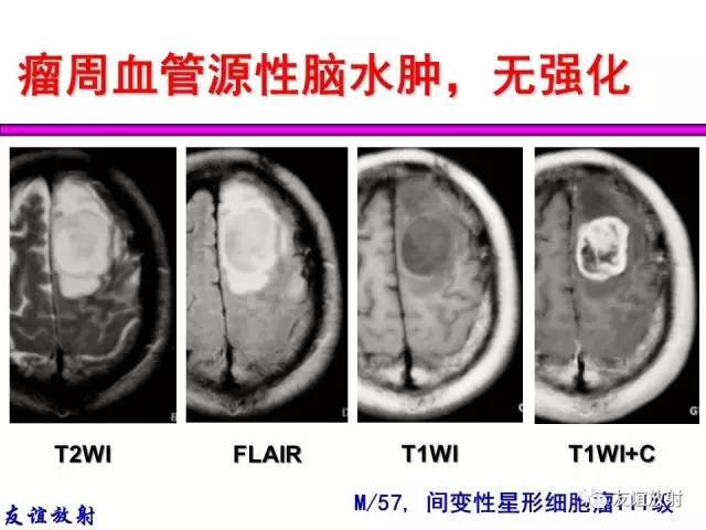 【PPT】基本病变的MRI信号分析：水肿、坏死、纤维化