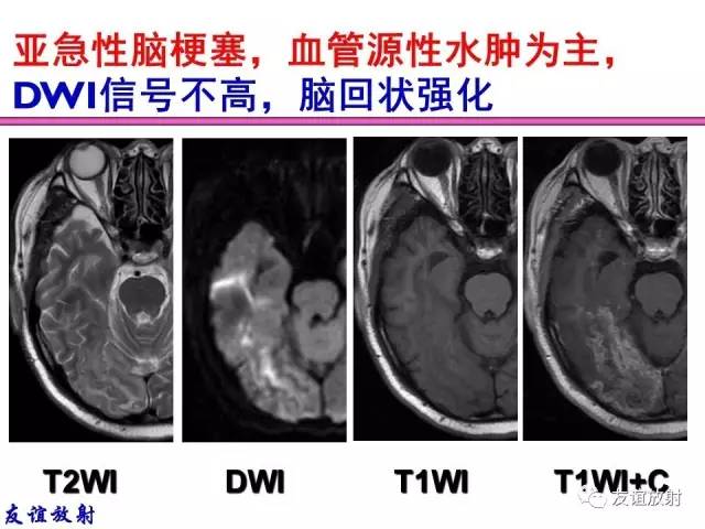 【PPT】基本病变的MRI信号分析：水肿、坏死、纤维化