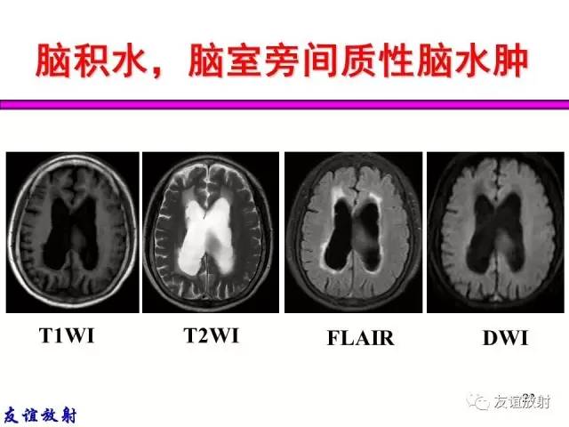 【PPT】基本病变的MRI信号分析：水肿、坏死、纤维化