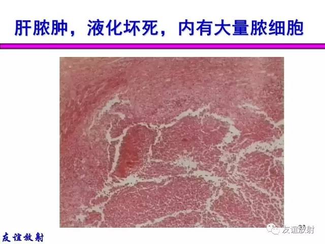 【PPT】基本病变的MRI信号分析：水肿、坏死、纤维化