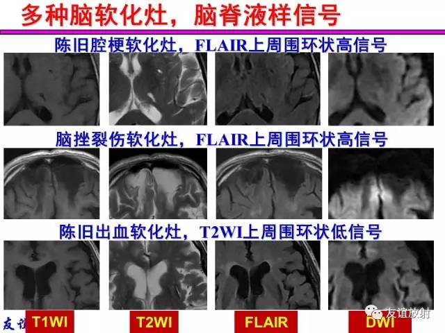 【PPT】基本病变的MRI信号分析：水肿、坏死、纤维化