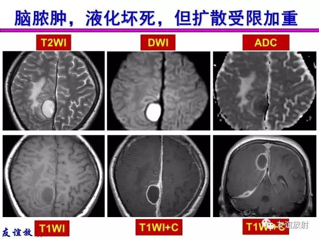 【PPT】基本病变的MRI信号分析：水肿、坏死、纤维化