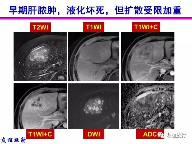 【PPT】基本病变的MRI信号分析：水肿、坏死、纤维化
