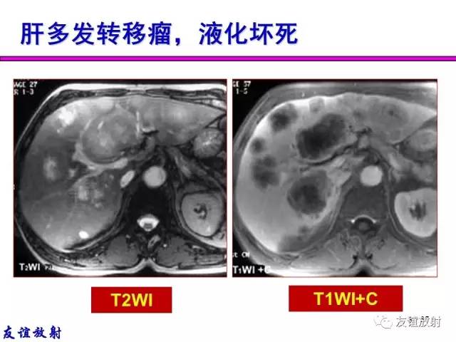 【PPT】基本病变的MRI信号分析：水肿、坏死、纤维化