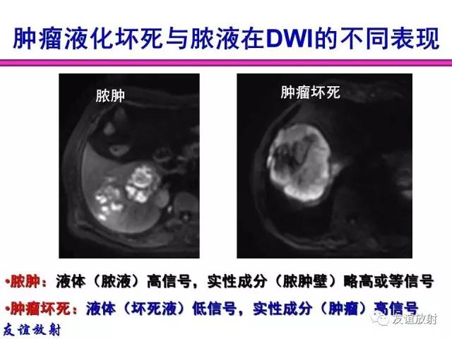 【PPT】基本病变的MRI信号分析：水肿、坏死、纤维化