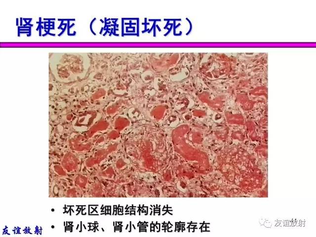 【PPT】基本病变的MRI信号分析：水肿、坏死、纤维化