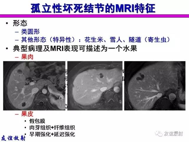 【PPT】基本病变的MRI信号分析：水肿、坏死、纤维化