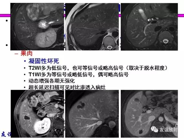 【PPT】基本病变的MRI信号分析：水肿、坏死、纤维化